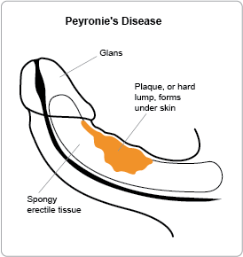 how a peyronie's disease penis looks